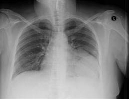 Italian Man's Heart Rotates 90 Degrees To The Right After Motorcycle Accident